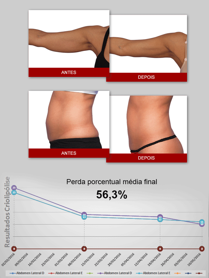 Gráfico de Resultado Criolipólise
